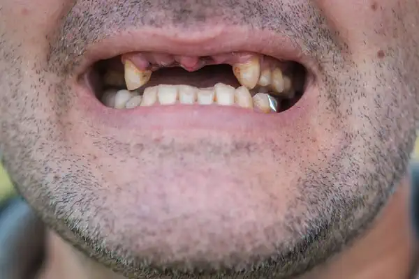 Who is a Good Candidate for Dental Implants (Full Mouth)?